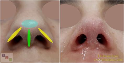 #1 what is a rim job exactly? We Performed Nose Tip Plasty Operation Using Alar Rim Grafts!