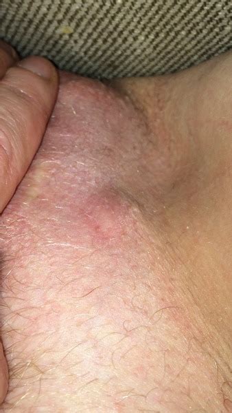 We put lotion on your legs and arms and. is this an abscess? pic included