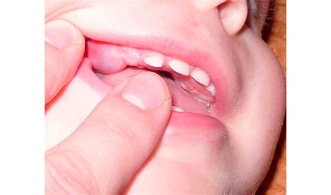 По мере прорезывания зуб упирается в слизистую оболочку. Десны при прорезывании зубов у детей-грудничков: фото ...