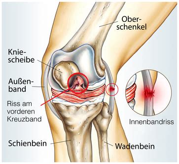 Häufig ist die innenseite des schienbeins betroffen. Kreuzbandriss » Symptome & Ursache bei einer Kreuzbandruptur