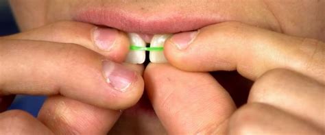 We did not find results for: Orthodontists warn against uptick in DIY teeth straightening - ABC News