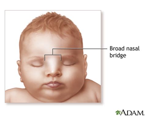 The epicanthic eye fold #soc119. Broad nasal bridge: MedlinePlus Medical Encyclopedia Image