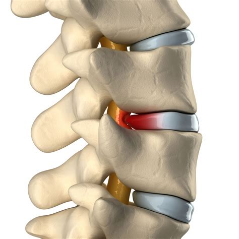 You will know how to relieve neck pain and any nerve related symptoms for both yourself or your clients in your massage business. Bulging Disc Non-Surgical Treatments | Novus Spine & Pain ...