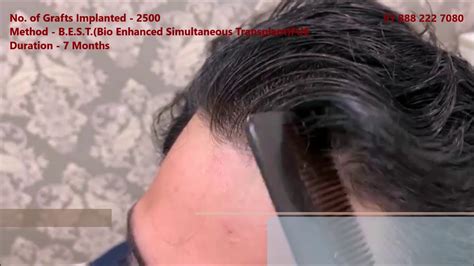 Yes, celebrities also go for this surgery. Excellent Natural Hair Transplant Results | Hair ...