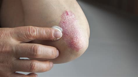 Modern imaging of the neurocutaneous syndromes. How the skin disease psoriasis costs us billions | MPR News