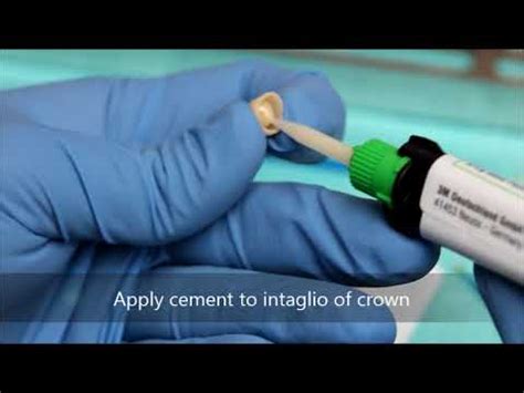 Jan 20, 2020 · zirconia crowns are made from zirconium dioxide, a very durable type of metal that's related to titanium, although it's categorized as a type of ceramic crown. Bonding a zirconia crown - YouTube