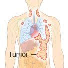 Primary malignant peritoneal mesothelioma 58. The 4 Mesothelioma Stages & Staging Systems Involved in ...