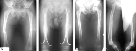 Figure 1 from Titanium elastic nail fixation for ...