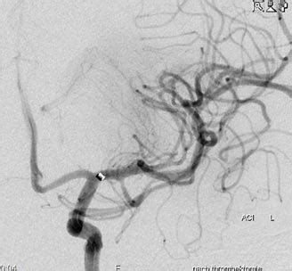 Der begriff „sinusvenenthrombose ist weit verbreitet; Akuttherapie des Schlaganfalls (Thrombektomie) - Neurovaskuläres Netzwerk Nordelbe