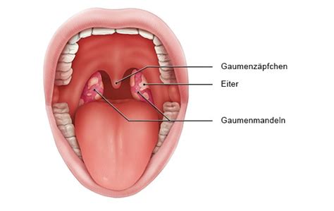 Zu den typischen symptomen der erkrankung zählen fieber, halsschmerzen und lymphknotenschwellungen. Mandelentzündung - UPD