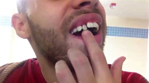 If you are figuratively, only time & perhaps a new special person in your life will stop ( or at they stop hurting faster the more you wear them though, so wear them as much as you can. Lingual Braces: Adding the last bracket - YouTube