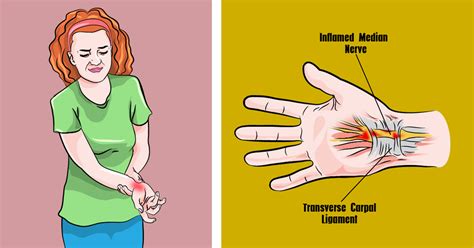 Carpal tunnel syndrome symptoms, including pain in the hands & wrists, affect about 4 percent of the general population. 5 Stretches To Prevent Carpal Tunnel Syndrome