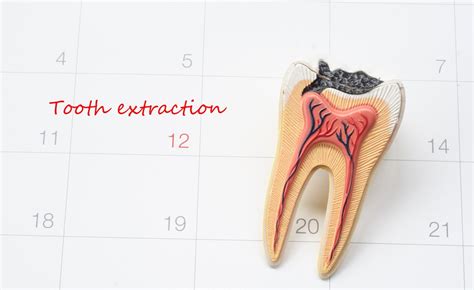 $4800….if they have to pull all (4) $5400. Tooth Extraction Cost - How Much Should You Pay? | Dental ...