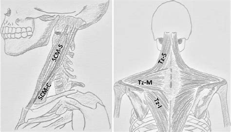 The video provides a walkthrough of the foramen of the skull (cranial foramina), including the cranial nerves that pass through each foramen. Functional anatomy of the accessory nerve studied through ...