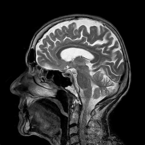 Investigational candidates in multiple sclerosis. IRM cérébrale - Je passe une IRM