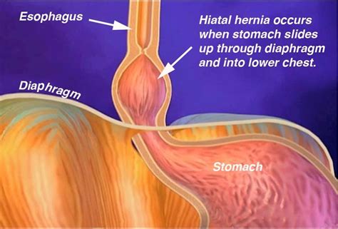 The commonest type of hernia is the sliding hiatal hernia where part of the stomach and junction where the esophagus joins the stomach slides up through the hole into the chest. The Health Website : Hiatus Hernia