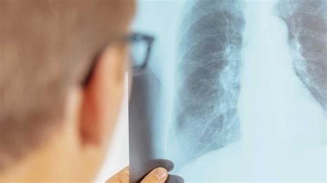 Les cancers du poumon sont la première cause de mortalité par cancer chez l'homme et probablement.bientôt chez la femme. Immunothérapie: le traitement de demain? - Le Soir Plus
