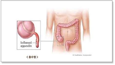 ■ 맹장염(충수염) 수술 늦어지면 충수가 터져 복막염 위험…소화기 장애와 비슷한 통증 매년 10만 ■ 젊은 층에서 자주 발생하는 맹장염(충수염)…통증 부위 알아둬야 급성 맹장염은 젊은 층에서 자주 발병. 부산항운병원