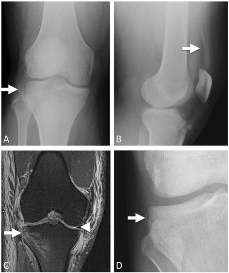 Segond fracture. a AP knee radiograph with large Segond ...