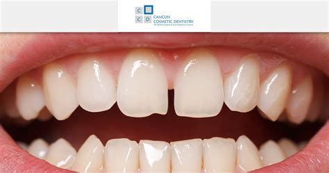 Sep 30, 2019 · the discoloration can be caused by the medications used to treat the infection inside the canals. How to fix big gaps between your teeth? - Cancun Cosmetic ...