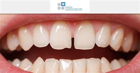 Nowadays there are also various ways to fix these dental gaps. How to fix big gaps between your teeth? - Cancun Cosmetic ...