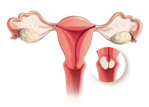 Most cervical cancer cases are caused by the sexually transmitted human papillomavirus (hpv). Cancer Council NSW Reveals: Australia Set To Be First ...