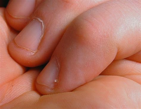 To treat an infected hangnail, follow the steps above in treating a normal hangnail followed by the application of a topical antibiotic cream and a bandage. Hangnail - Wikipedia