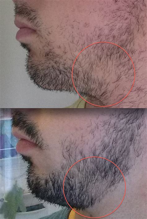 Как избавить волосы борода