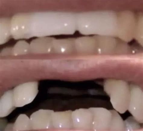 You want buck teeth or frankenstein teeth to appear large with flat bottoms, to give them a large do not wear false costume teeth if you have braces, veneers or caps, as the denture adhesive or. Quick Dental Tooth™ Temporary DIY Tooth Kit False Teeth REPLACEMENT | Tooth replacement, False ...