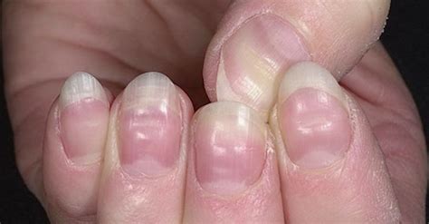 A lot of people do it when they don't know they're doing it. Studying Your Nails Could Reveal Important Warnings Your ...