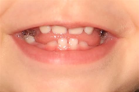 Сүүн шүд байнгын шүд шүдлэлт - Shud.mn | Dentistry
