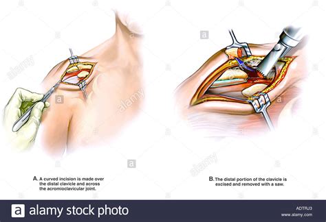 What kind of account is a joint account? Shoulder Surgery - Open Mumford Procedure Stock Photo - Alamy