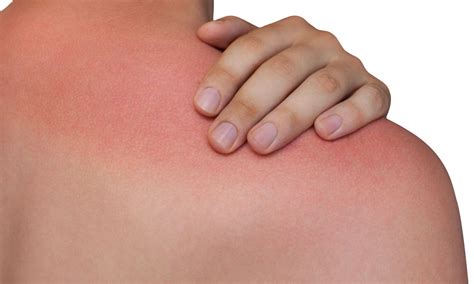 Badly sunburnt after a day in the sun? Sunburn Treatment in Columbus | Eastside Dermatology