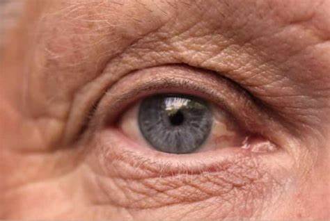 Concentrate on tracks down connect between eye sicknesses and Alzheimer's