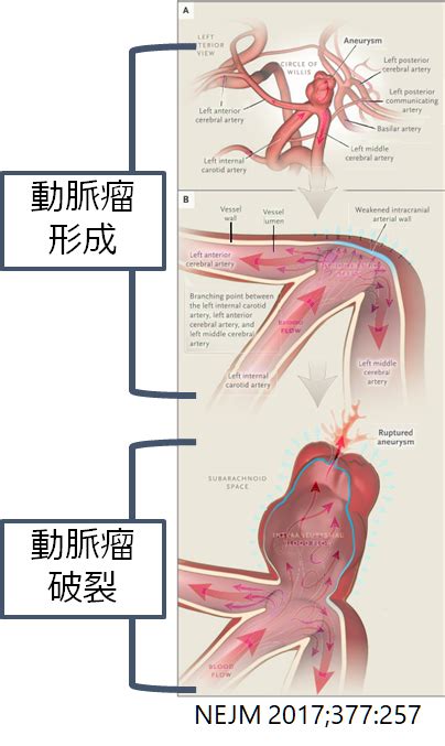 The site owner hides the web page description. くも膜下出血 診断 - 医学事始 いがくことはじめ