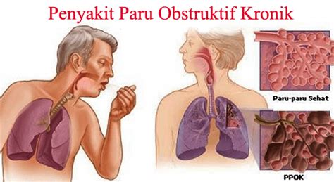 Check 'penyakit paru obstruktif kronik' translations into english. Hubungan Merokok dan COPD atau PPOK ( Penyakit paru ...