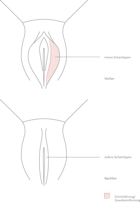 Manchmal kann es schwierig sein, sich komplett wohl in seinem körper zu das inner labia piercing gilt vor allem als dekoratives piercing und hat keinen nachweislichen sexuellen. Schamlippenverkleinerung beim Facharzt | BORGES AESTHETICS