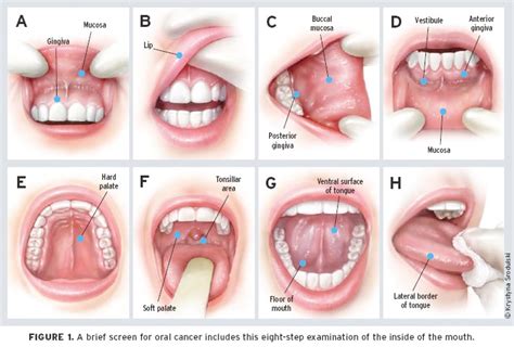 Hughes it or lose it? Mouth or Oral Cancer - Malmin Dental Blog