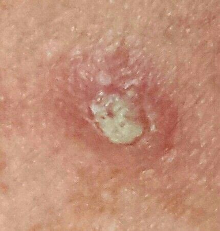 These are the things that you're trying to look for in an earlier stage. Squamous cell carcinoma. Looks like a volcano. | Squamous ...