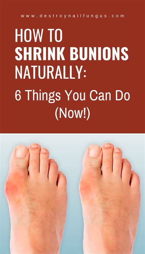 A natural approach to bunion rehabilitation can, in many cases, be very helpful in preventing the deformity from getting worse, though this always depends on the severity of the bunion and how long the problem has existed before beginning a foot and toe rehabilitation program. How To Shrink Bunions Naturally: 6 Things You Can Do (Now ...