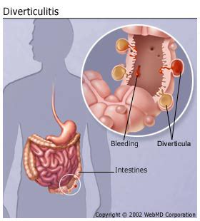 Leukocytosis is a condition that causes you to have too many white blood cells (wbc). Diverticulitis. Causes, symptoms, treatment Diverticulitis