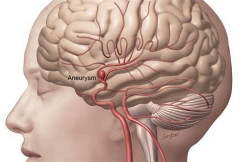 Because of the constant pressure of the circulating blood within the artery, the. Beda dengan Stroke, Ini 7 Fakta Seputar Aneurisma yang ...