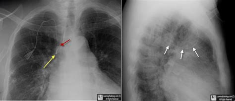 These are implemented at catheter insertion and for the duration of its use. Learning Radiology - Central, Venous, Catheter, Azygos, Vein