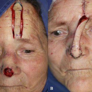 (PDF) Paramedian forehead flap for nasal tip reconstruction after Mohs ...