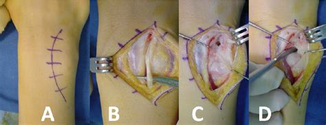 Das prognostizierte fallzahlwachstum basiert auf angaben zur. a). Open surgery for TFCC type 1B lesion repair. (A) Skin ...