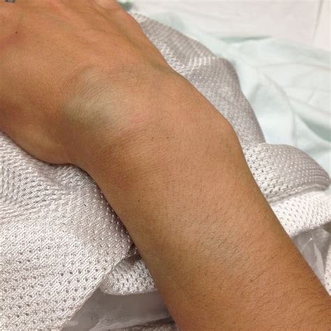 What your wrist fracture may be telling you? OLD STINKY CAT LADY: Broken wrist.