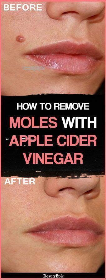 While many moles arise in the first years of life, the ideally, mole prevention is more effective than later trying to remove moles that have already. Apple Cider Vinegar for moles #AvocadoHomeRemedies # ...
