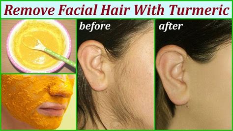 Friend's turmeric is a natural spice that has been used since earlier times to enhance our beauty and has enough properties to remove unwanted facial hair easily. Facial Hair Removal: Turmeric for Hair Removal | Good ...