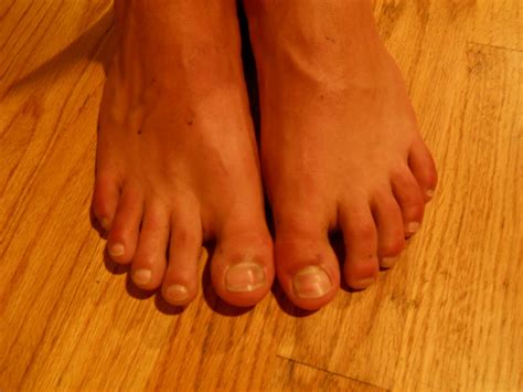 They usually occur after an acute injury although repetitive forced upward movement of the great toe may also lead to an injury of the tissue. Pontoon Mama's Blog: Turf Toe