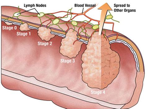 How do you prevent it? This Is All You Need To Know About Colorectal Cancer - How ...